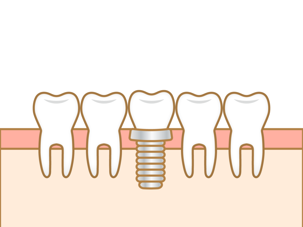 インプラント治療